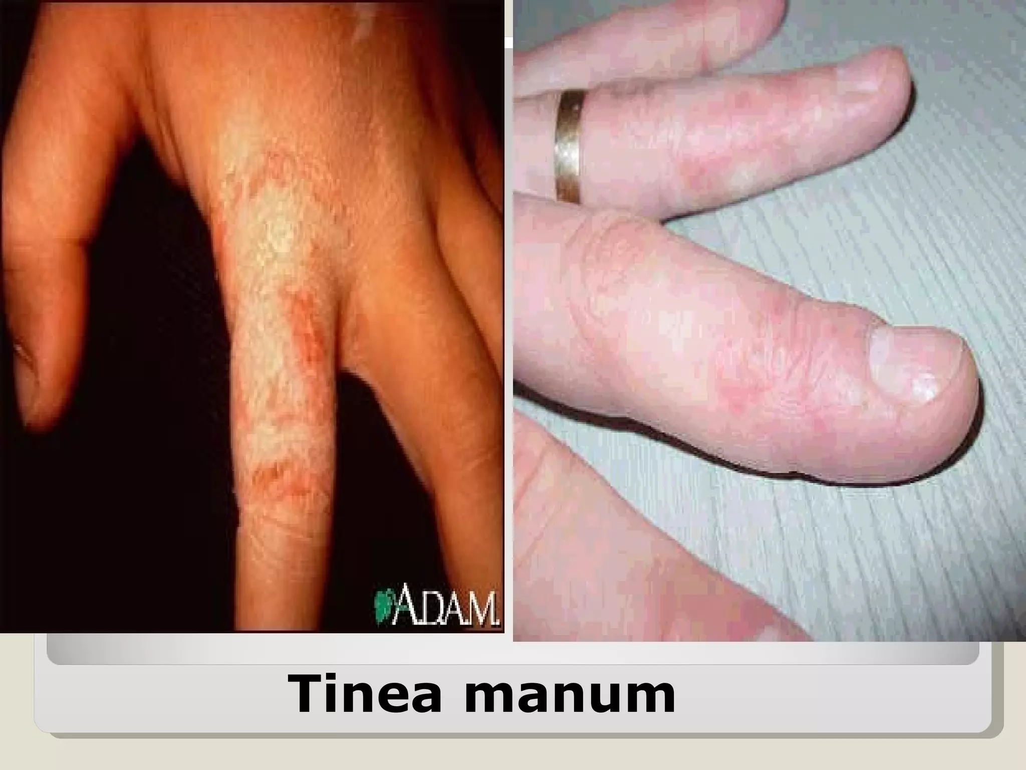 Tinea manum
 