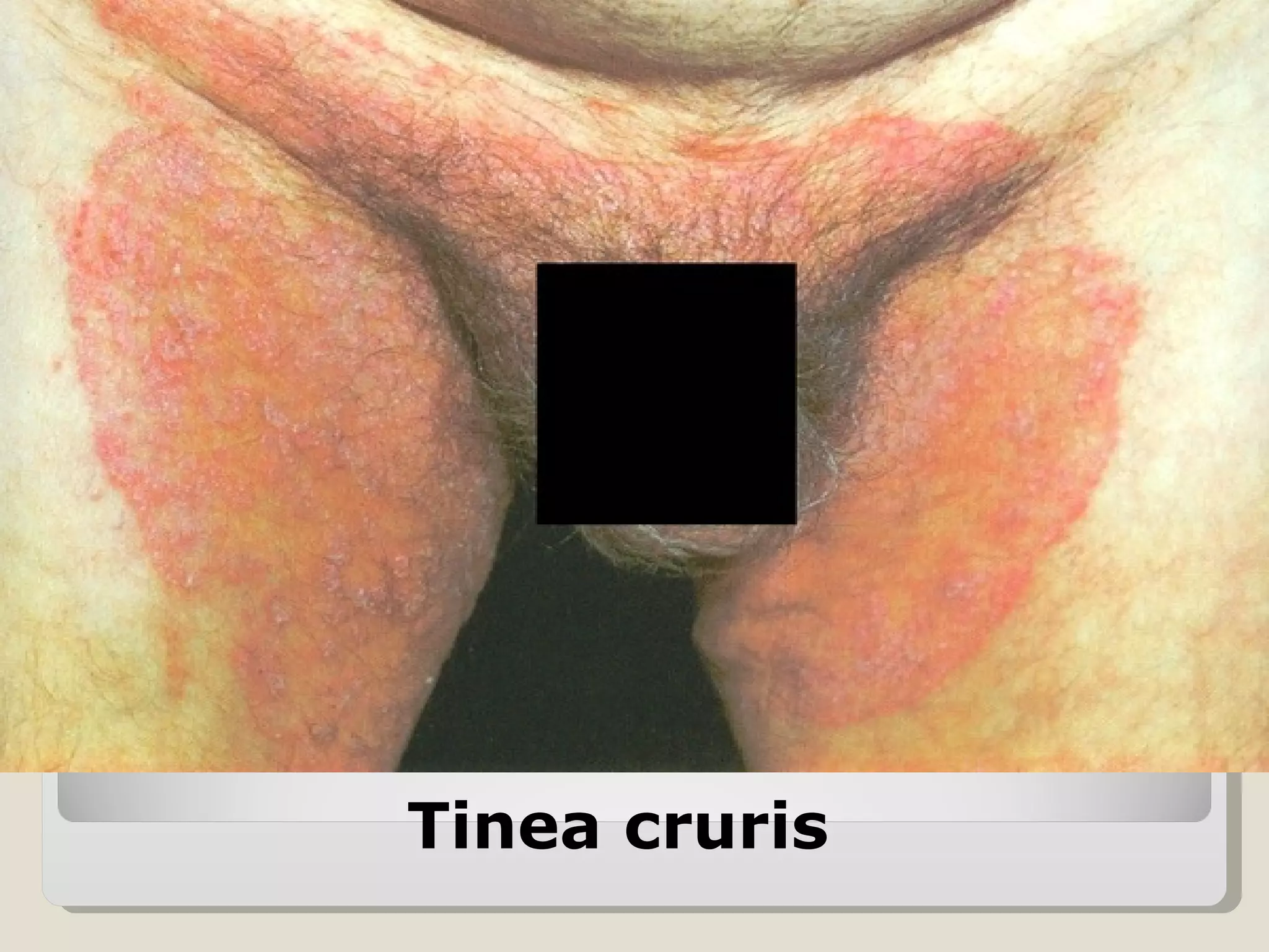 Tinea cruris
 
