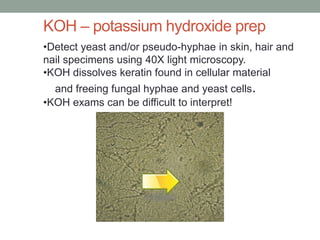 •Detect yeast and/or pseudo-hyphae in skin, hair and
nail specimens using 40X light microscopy.
•KOH dissolves keratin found in cellular material
and freeing fungal hyphae and yeast cells.
•KOH exams can be difficult to interpret!
KOH – potassium hydroxide prep
 