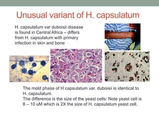 The mold phase of H capsulatum var. duboisii is identical to
H. capsulatum.
The difference is the size of the yeast cells: Note yeast cell is
8 – 10 uM which is 2X the size of H. capsulatum yeast cell.
H. capsulatum var duboisii disease
is found in Central Africa – differs
from H. capsulatum with primary
infection in skin and bone
Unusual variant of H. capsulatum
 