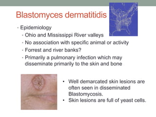 Blastomyces dermatitidis
• Epidemiology
• Ohio and Mississippi River valleys
• No association with specific animal or activity
• Forrest and river banks?
• Primarily a pulmonary infection which may
disseminate primarily to the skin and bone
• Well demarcated skin lesions are
often seen in disseminated
Blastomycosis.
• Skin lesions are full of yeast cells.
 