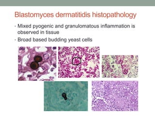 Blastomyces dermatitidis histopathology
• Mixed pyogenic and granulomatous inflammation is
observed in tissue
• Broad based budding yeast cells
 