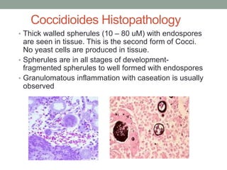 Coccidioides Histopathology
• Thick walled spherules (10 – 80 uM) with endospores
are seen in tissue. This is the second form of Cocci.
No yeast cells are produced in tissue.
• Spherules are in all stages of development-
fragmented spherules to well formed with endospores
• Granulomatous inflammation with caseation is usually
observed
 