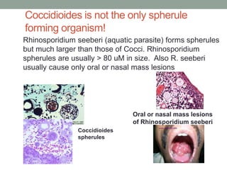 Rhinosporidium seeberi (aquatic parasite) forms spherules
but much larger than those of Cocci. Rhinosporidium
spherules are usually > 80 uM in size. Also R. seeberi
usually cause only oral or nasal mass lesions
Oral or nasal mass lesions
of Rhinosporidium seeberi
Coccidioides
spherules
Coccidioides is not the only spherule
forming organism!
 