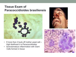 Tissue Exam of
Paracoccidioides brasiliensis
• If more than 2 buds off mother yeast cell –
High likelihood it is Paracoccidioides
• Granulomatous inflammation with Giant
Cells formed in tissue
 