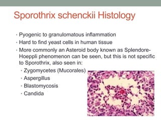 Sporothrix schenckii Histology
• Pyogenic to granulomatous inflammation
• Hard to find yeast cells in human tissue
• More commonly an Asteroid body known as Splendore-
Hoeppli phenomenon can be seen, but this is not specific
to Sporothrix, also seen in:
• Zygomycetes (Mucorales)
• Aspergillus
• Blastomycosis
• Candida
 