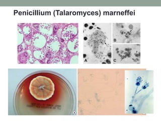 Penicillium (Talaromyces) marneffei
 