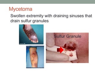 Swollen extremity with draining sinuses that
drain sulfur granules
Sulfur Granule
Mycetoma
 