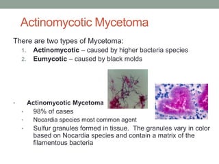 Actinomycotic Mycetoma
There are two types of Mycetoma:
1. Actinomycotic – caused by higher bacteria species
2. Eumycotic – caused by black molds
• Actinomycotic Mycetoma
• 98% of cases
• Nocardia species most common agent
• Sulfur granules formed in tissue. The granules vary in color
based on Nocardia species and contain a matrix of the
filamentous bacteria
 