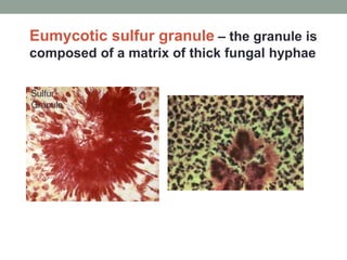 Eumycotic sulfur granule – the granule is
composed of a matrix of thick fungal hyphae
 
