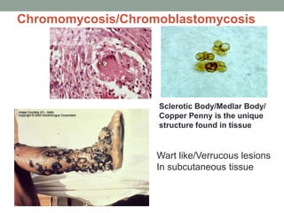 Chromomycosis/Chromoblastomycosis
Wart like/Verrucous lesions
In subcutaneous tissue
Sclerotic Body/Medlar Body/
Copper Penny is the unique
structure found in tissue
 