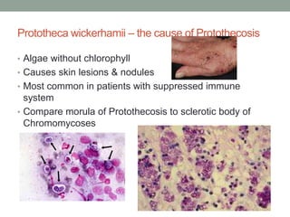 Prototheca wickerhamii – the cause of Protothecosis
• Algae without chlorophyll
• Causes skin lesions & nodules
• Most common in patients with suppressed immune
system
• Compare morula of Protothecosis to sclerotic body of
Chromomycoses
 