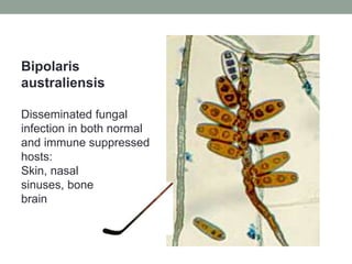 Bipolaris
australiensis
Disseminated fungal
infection in both normal
and immune suppressed
hosts:
Skin, nasal
sinuses, bone
brain
 