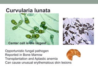 Curvularia lunata
Center cell is the largest
Opportunistic fungal pathogen
Reported in Bone Marrow
Transplantation and Aplastic anemia
Can cause unusual erythematous skin lesions
 