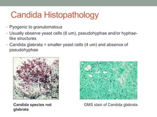 Candida Histopathology
• Pyogenic to granulomatous
• Usually observe yeast cells (8 um), pseudohyphae and/or hyphae-
like structures
• Candida glabrata = smaller yeast cells (4 um) and absence of
pseudohyphae
GMS stain of Candida glabrataCandida species not
glabrata
 