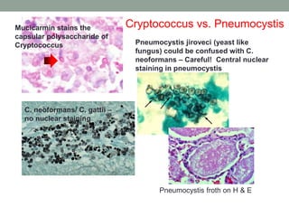 Mucicarmin stains the
capsular polysaccharide of
Cryptococcus Pneumocystis jiroveci (yeast like
fungus) could be confused with C.
neoformans – Careful! Central nuclear
staining in pneumocystis
C. neoformans/ C. gattii –
no nuclear staining
Cryptococcus vs. Pneumocystis
Pneumocystis froth on H & E
 