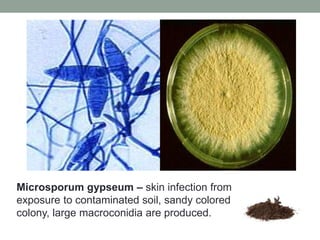 Microsporum gypseum – skin infection from
exposure to contaminated soil, sandy colored
colony, large macroconidia are produced.
 
