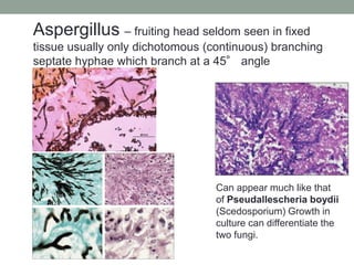 Aspergillus – fruiting head seldom seen in fixed
tissue usually only dichotomous (continuous) branching
septate hyphae whi...