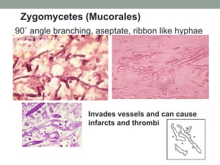 90˚ angle branching, aseptate, ribbon like hyphae
Invades vessels and can cause
infarcts and thrombi
Zygomycetes (Mucorale...