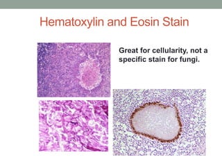 Great for cellularity, not a
specific stain for fungi.
Hematoxylin and Eosin Stain
 