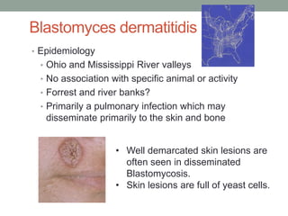 Blastomyces dermatitidis
• Epidemiology
• Ohio and Mississippi River valleys
• No association with specific animal or acti...