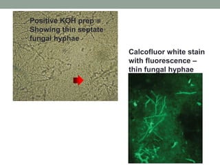 Positive KOH prep
Showing thin septate
fungal hyphae
Calcofluor white stain
with fluorescence –
thin fungal hyphae
 