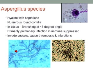 Aspergillus species
• Hyaline with septations
• Numerous round conidia
• In tissue - Branching at 45 degree angle
• Primarily pulmonary infection in immune suppressed
• Invade vessels, cause thrombosis & infarctions
 