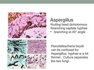 Aspergillus
•fruiting head dichotomous
•branching septate hyphae
• branching at 45* angle
Pseudallescheria boydii
can be confused for
Aspergillus, hyphae is a bit
thinner. Culture separates
the two fungi.
 