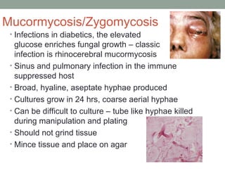 Mucormycosis/Zygomycosis
• Infections in diabetics, the elevated
glucose enriches fungal growth – classic
infection is rhi...