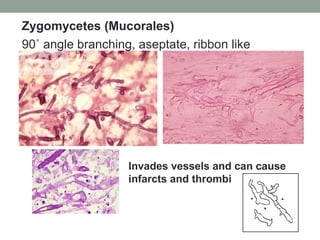 90˚ angle branching, aseptate, ribbon like
Invades vessels and can cause
infarcts and thrombi
Zygomycetes (Mucorales)
 