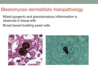 Blastomyces dermatitidis histopathology
Mixed pyogenic and granulomatous inflammation is
observed in tissue with
Broad based budding yeast cells
 