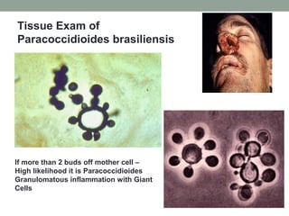 Tissue Exam of
Paracoccidioides brasiliensis
If more than 2 buds off mother cell –
High likelihood it is Paracoccidioides
Granulomatous inflammation with Giant
Cells
 