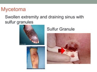 Swollen extremity and draining sinus with
sulfur granules
Sulfur Granule
Mycetoma
 