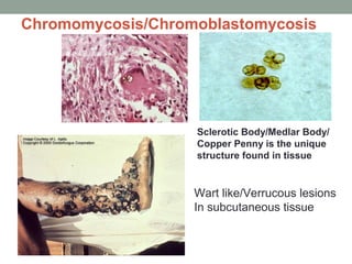 Chromomycosis/Chromoblastomycosis
Wart like/Verrucous lesions
In subcutaneous tissue
Sclerotic Body/Medlar Body/
Copper Pe...