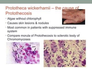 Prototheca wickerhamii – the cause of
Protothecosis
• Algae without chlorophyll
• Causes skin lesions & nodules
• Most common in patients with suppressed immune
system
• Compare morula of Protothecosis to sclerotic body of
Chromomycoses
 
