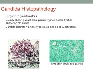Candida Histopathology
• Pyogenic to granulomatous
• Usually observe yeast cells, pseudohyphae and/or hyphae
appearing str...