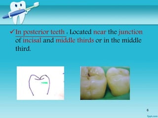 Contacts and Contours By Dr.Ruchir Kapur | PPTX