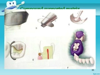 Contacts and Contours By Dr.Ruchir Kapur | PPTX