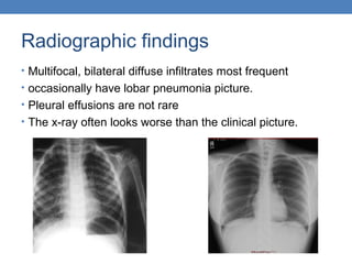 Radiographic findings
• Multifocal, bilateral diffuse infiltrates most frequent
• occasionally have lobar pneumonia picture.
• Pleural effusions are not rare
• The x-ray often looks worse than the clinical picture.

 