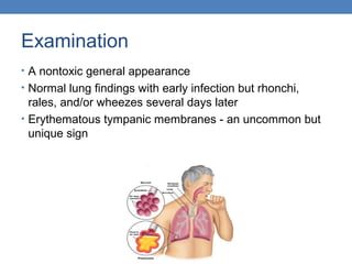Examination
• A nontoxic general appearance
• Normal lung findings with early infection but rhonchi,

rales, and/or wheezes several days later
• Erythematous tympanic membranes - an uncommon but
unique sign

 