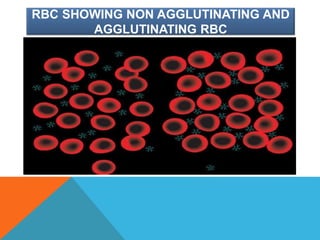 RBC SHOWING NON AGGLUTINATING AND
AGGLUTINATING RBC
 