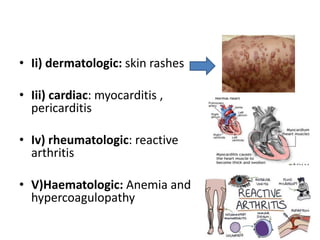 • Ii) dermatologic: skin rashes
• Iii) cardiac: myocarditis ,
pericarditis
• Iv) rheumatologic: reactive
arthritis
• V)Haematologic: Anemia and
hypercoagulopathy
 