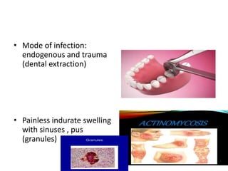 • Mode of infection:
endogenous and trauma
(dental extraction)
• Painless indurate swelling
with sinuses , pus
(granules)
 