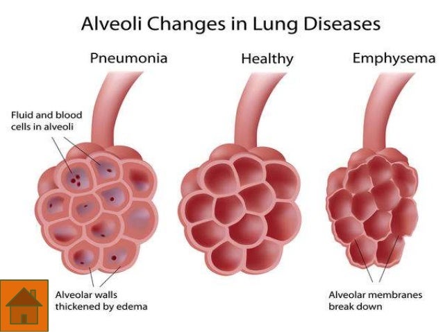 Mycoplasma pneumonia
