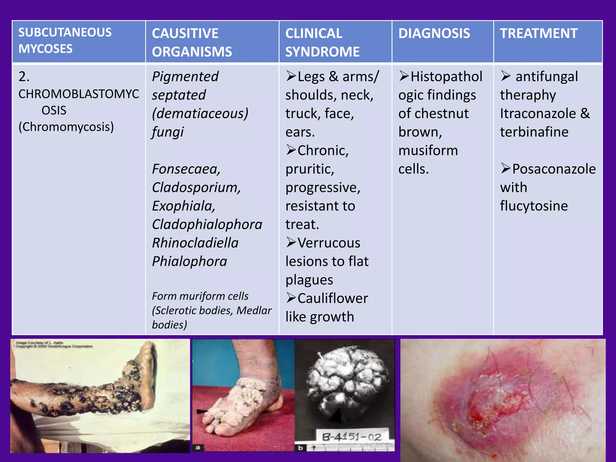 SUBCUTANEOUS     CAUSITIVE                   CLINICAL          DIAGNOSIS       TREATMENT
MYCOSES          ORGANISMS                   SYNDROME
2.              Pigmented                    Legs & arms/     Histopathol     antifungal
CHROMOBLASTOMYC septated                     shoulds, neck,    ogic findings   theraphy
    OSIS        (dematiaceous)               truck, face,      of chestnut     Itraconazole &
(Chromomycosis) fungi                        ears.             brown,          terbinafine
                                             Chronic,         musiform
                 Fonsecaea,                  pruritic,         cells.          Posaconazole
                 Cladosporium,               progressive,                      with
                 Exophiala,                  resistant to                      flucytosine
                 Cladophialophora            treat.
                 Rhinocladiella              Verrucous
                 Phialophora                 lesions to flat
                                             plagues
                 Form muriform cells         Cauliflower
                 (Sclerotic bodies, Medlar
                 bodies)
                                             like growth
 