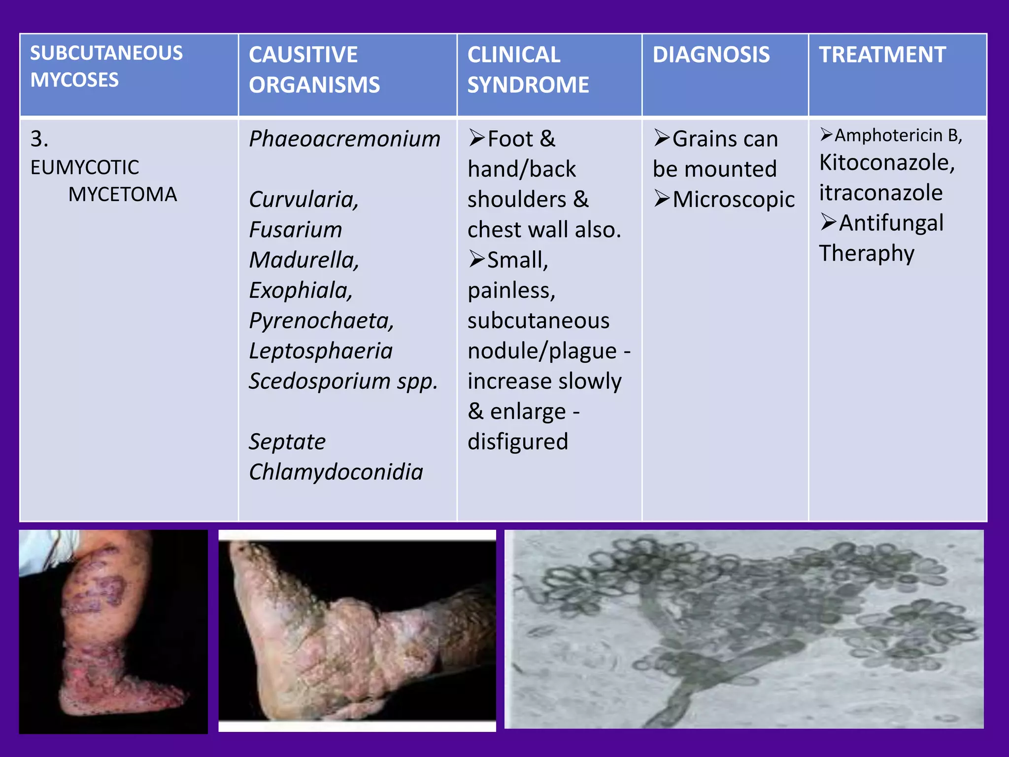 SUBCUTANEOUS   CAUSITIVE           CLINICAL        DIAGNOSIS       TREATMENT
MYCOSES        ORGANISMS           SYNDROME

3.             Phaeoacremonium     Foot &          Grains can    Amphotericin B,
EUMYCOTIC                          hand/back        be mounted     Kitoconazole,
   MYCETOMA    Curvularia,         shoulders &      Microscopic   itraconazole
               Fusarium            chest wall also.                Antifungal
               Madurella,          Small,                         Theraphy
               Exophiala,          painless,
               Pyrenochaeta,       subcutaneous
               Leptosphaeria       nodule/plague -
               Scedosporium spp.   increase slowly
                                   & enlarge -
               Septate             disfigured
               Chlamydoconidia
 