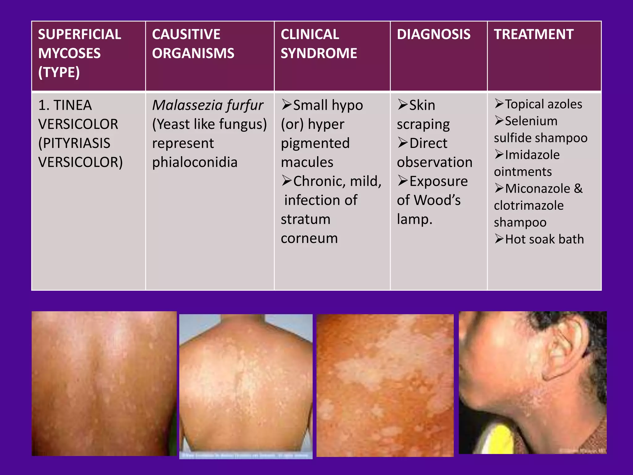 SUPERFICIAL   CAUSITIVE             CLINICAL          DIAGNOSIS     TREATMENT
MYCOSES       ORGANISMS             SYNDROME
(TYPE)

1. TINEA      Malassezia furfur     Small hypo       Skin         Topical azoles
VERSICOLOR    (Yeast like fungus)   (or) hyper        scraping      Selenium
(PITYRIASIS   represent             pigmented         Direct       sulfide shampoo
                                                                    Imidazole
VERSICOLOR)   phialoconidia         macules           observation
                                                                    ointments
                                    Chronic, mild,   Exposure     Miconazole &
                                     infection of     of Wood’s     clotrimazole
                                    stratum           lamp.         shampoo
                                    corneum                         Hot soak bath
 