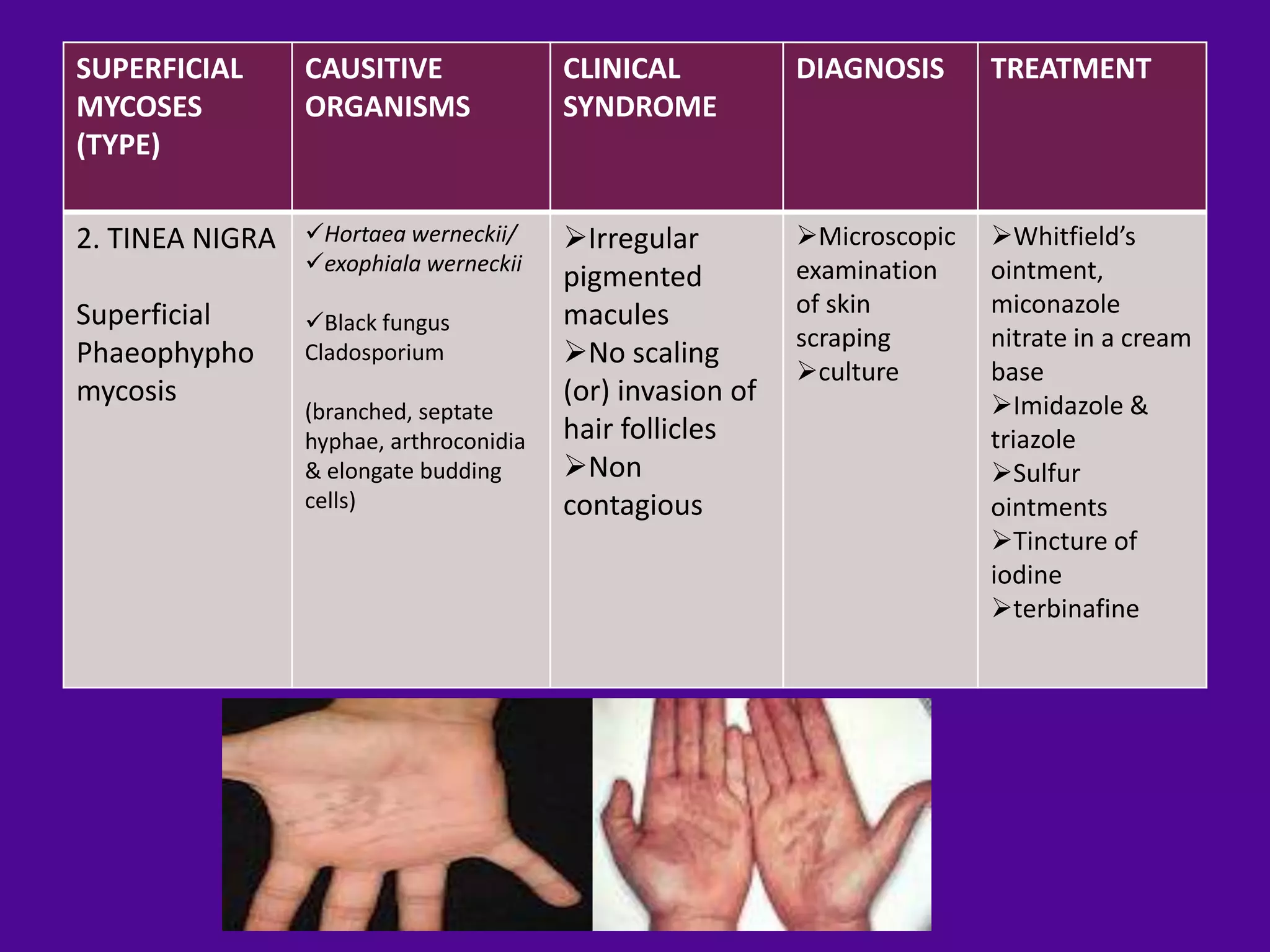 SUPERFICIAL      CAUSITIVE               CLINICAL           DIAGNOSIS      TREATMENT
MYCOSES          ORGANISMS               SYNDROME
(TYPE)

2. TINEA NIGRA   Hortaea werneckii/     Irregular         Microscopic   Whitfield’s
                 exophiala werneckii                       examination    ointment,
                                         pigmented
Superficial                              macules            of skin        miconazole
                 Black fungus
                                                            scraping       nitrate in a cream
Phaeophypho      Cladosporium            No scaling
                                                            culture       base
mycosis                                  (or) invasion of                  Imidazole &
                 (branched, septate
                 hyphae, arthroconidia   hair follicles                    triazole
                 & elongate budding      Non                              Sulfur
                 cells)                  contagious                        ointments
                                                                           Tincture of
                                                                           iodine
                                                                           terbinafine
 