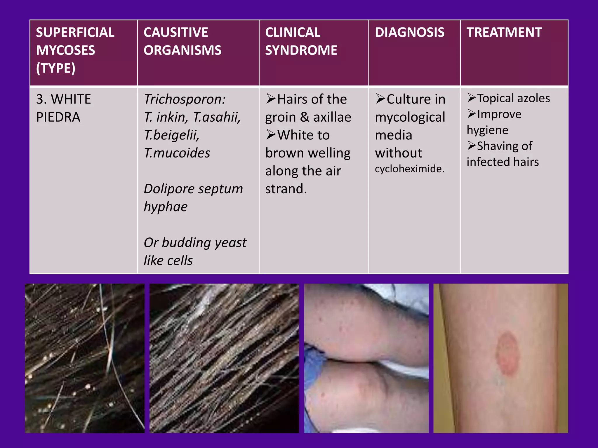 SUPERFICIAL   CAUSITIVE             CLINICAL          DIAGNOSIS        TREATMENT
MYCOSES       ORGANISMS             SYNDROME
(TYPE)

3. WHITE      Trichosporon:         Hairs of the     Culture in      Topical azoles
PIEDRA        T. inkin, T.asahii,   groin & axillae   mycological      Improve
              T.beigelii,           White to         media            hygiene
                                                                       Shaving of
              T.mucoides            brown welling     without
                                                      cycloheximide.
                                                                       infected hairs
                                    along the air
              Dolipore septum       strand.
              hyphae

              Or budding yeast
              like cells
 