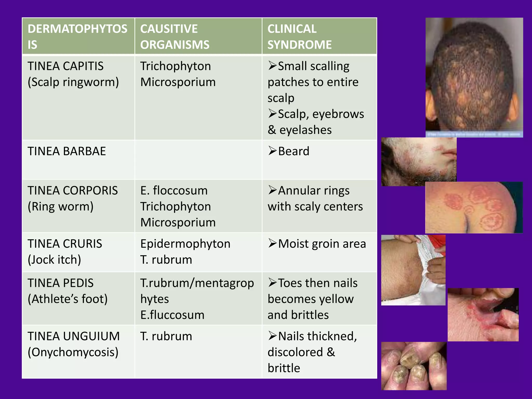 DERMATOPHYTOS CAUSITIVE                CLINICAL
IS            ORGANISMS                SYNDROME
TINEA CAPITIS      Trichophyton        Small scalling
(Scalp ringworm)   Microsporium        patches to entire
                                       scalp
                                       Scalp, eyebrows
                                       & eyelashes
TINEA BARBAE                           Beard

TINEA CORPORIS     E. floccosum        Annular rings
(Ring worm)        Trichophyton        with scaly centers
                   Microsporium
TINEA CRURIS       Epidermophyton      Moist groin area
(Jock itch)        T. rubrum
TINEA PEDIS        T.rubrum/mentagrop Toes then nails
(Athlete’s foot)   hytes              becomes yellow
                   E.fluccosum        and brittles
TINEA UNGUIUM      T. rubrum           Nails thickned,
(Onychomycosis)                        discolored &
                                       brittle
 